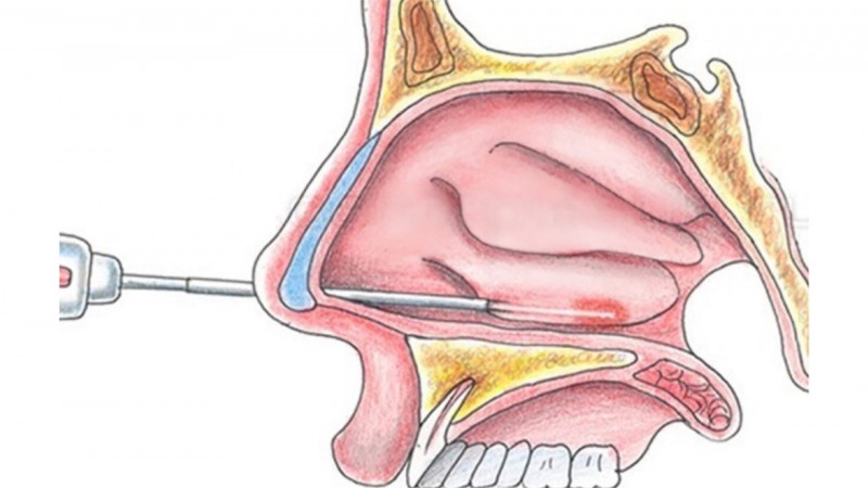 Вазотомия нижних носовых раковин (хирургическое лечение ринита)